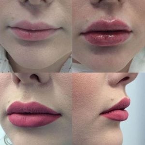 Inyecciones cosméticas del labio del gel líquido del llenador del aumento del labio de la seguridad de la belleza