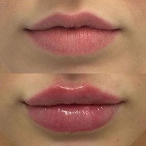 Efecto significativo prellenado de la recuperación del llenador del aumento del labio de la jeringuilla rápidamente