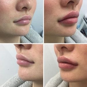 Inyecciones cosméticas del labio del gel líquido del llenador del aumento del labio de la seguridad de la belleza