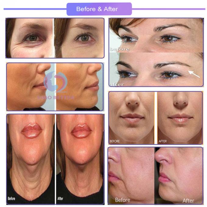 los hilos de la piel del lifting facial del hilo que levantan la sutura roscan los productos para el cuidado de la piel absorbibles